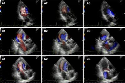 Flow dynamic assessment of native mitral valve, mitral valve repair and mitral valve replacement using vector flow mapping intracardiac flow dynamic in mitral valve regurgitation